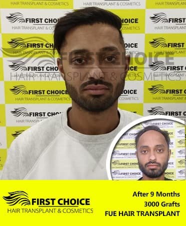 before-after-arvinder