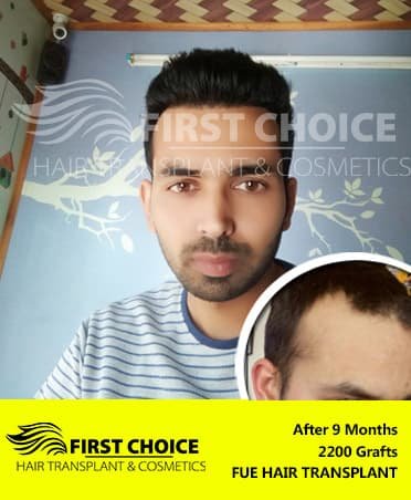 before-after-hair-transplant