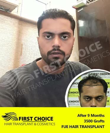 before-after-mandeep